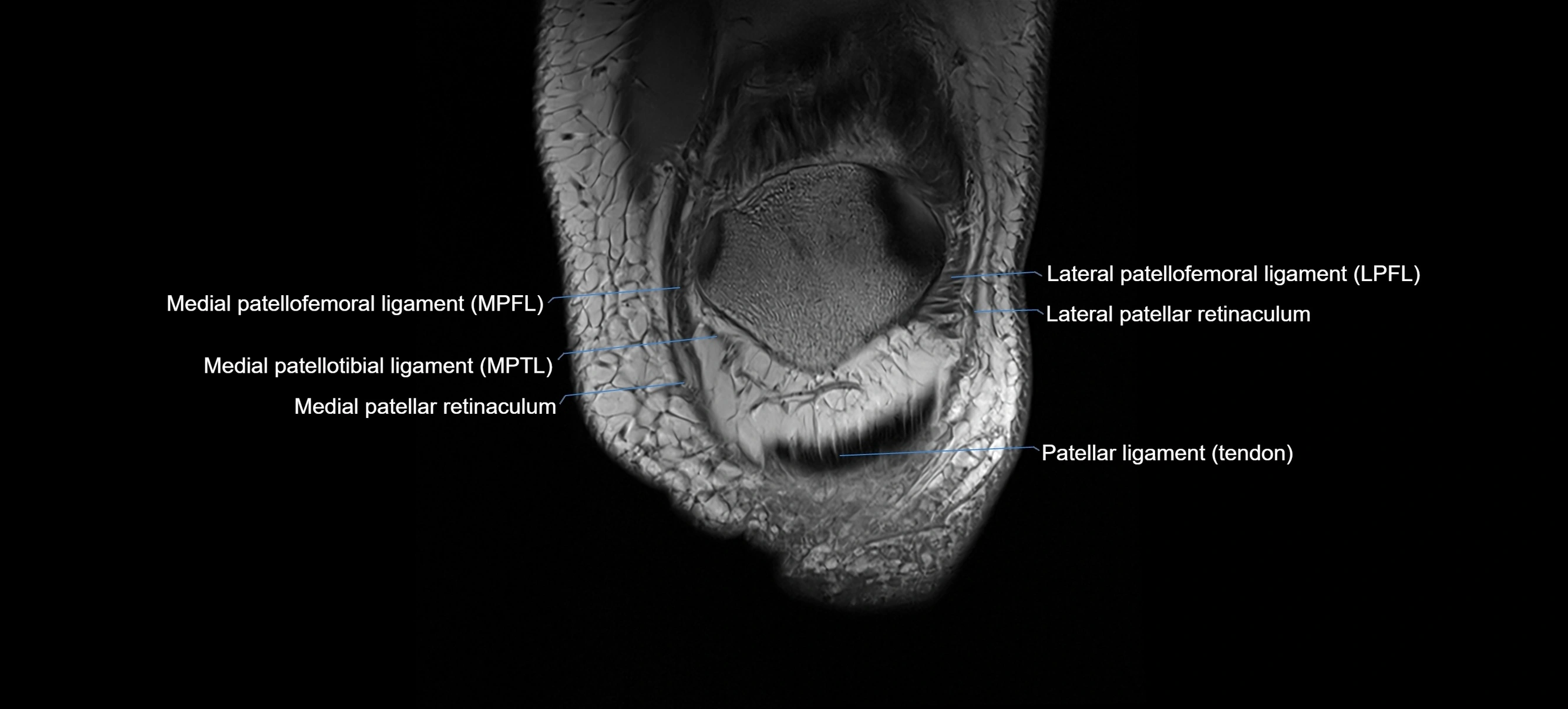 MRI coronal  ligaments cross sectional anatomy 3T  radiology  image-img-04001-00006.webp